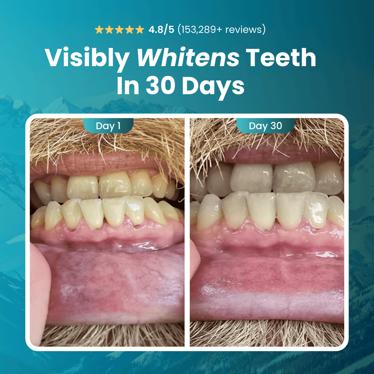 Teeth whitening before and after 30 days, Image2_c52b5ec1